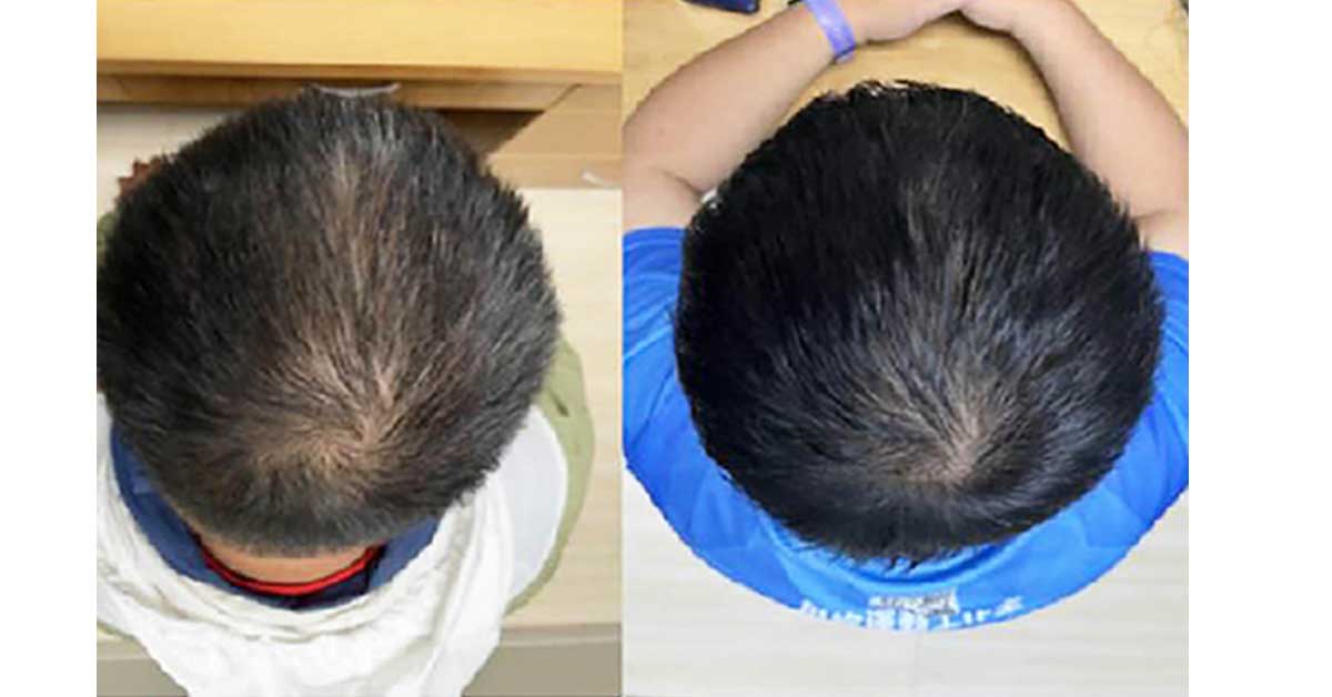 Scientists-Say-Hair-Could-Regrow-in-56-Days,-But-Is-It-Actually-True
